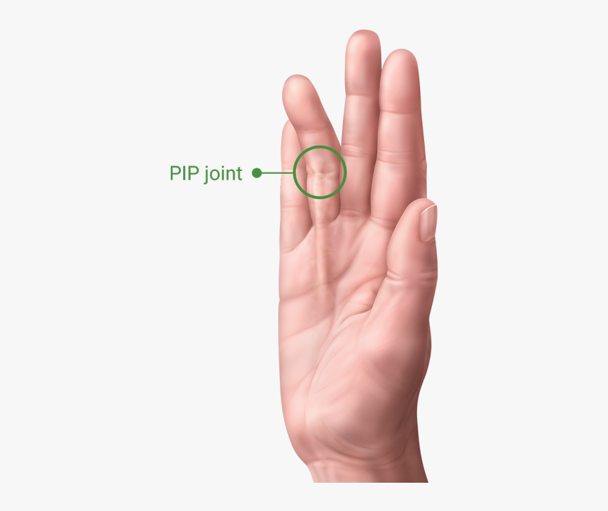 A Hand With Dupuytren’s Contracture Showing The Pip - Ring, HD Png Download, Free Download