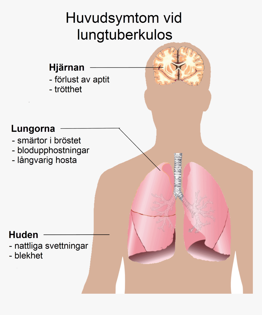 Pulmonary Tuberculosis Symptoms Swedish - Tuberculosis Wikipedia, HD Png Download, Free Download