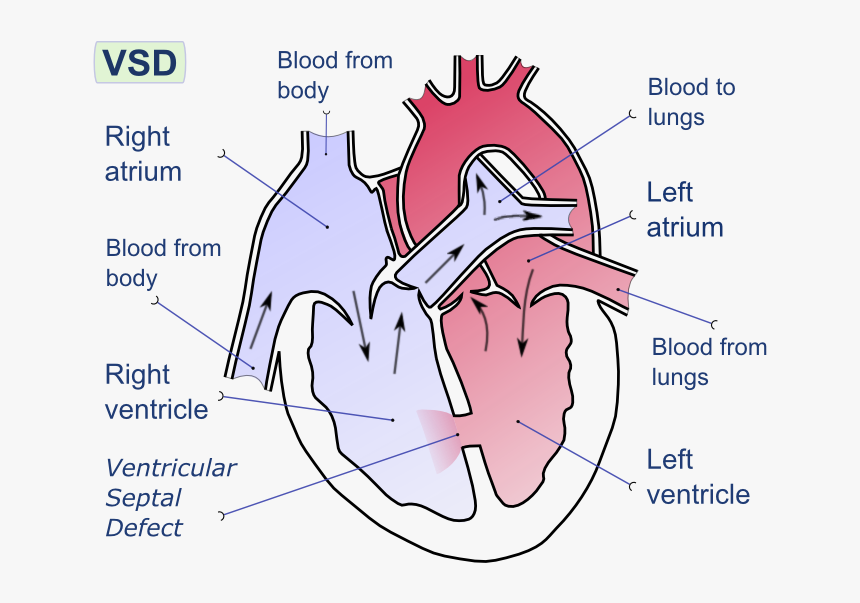 Ventricular Septal Defect-en - Interatrial Septum, HD Png Download, Free Download