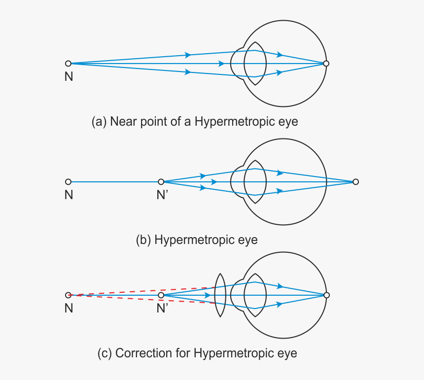 Presbyopia Correction Presbyopia Diagram, HD Png Download, Free Download