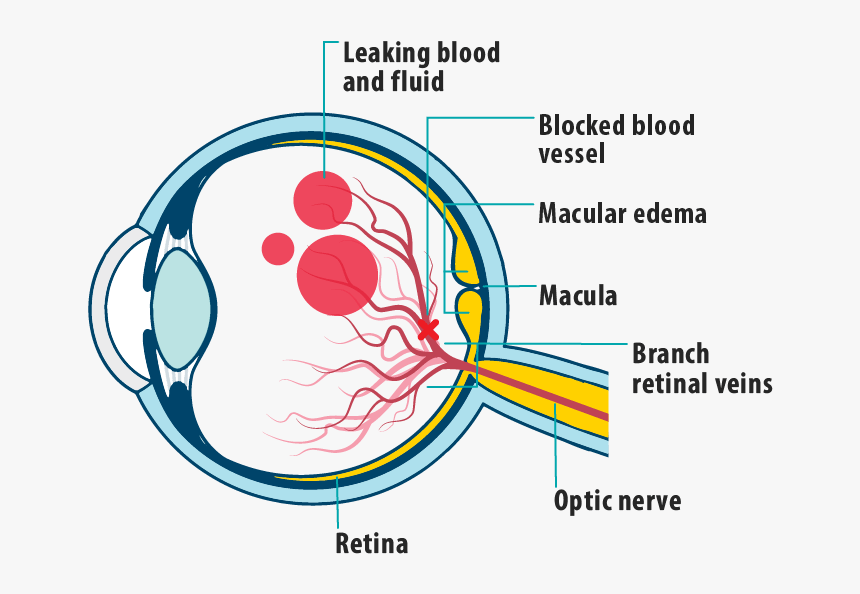 Picture Of Effects Of Mefbrvo On The Eye, Showing Leaking - Crvo With Macular Edema, HD Png Download, Free Download