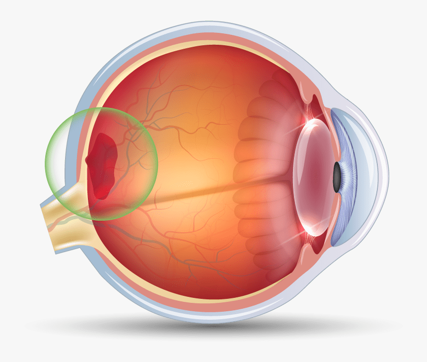 Age-related Macular Degeneration In The Eye - Retina, HD Png Download, Free Download