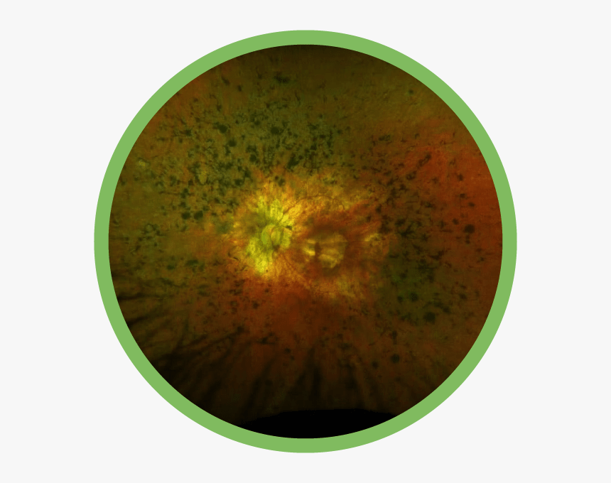 Inherited Retinal Disease - Odin Blockchain, HD Png Download, Free Download