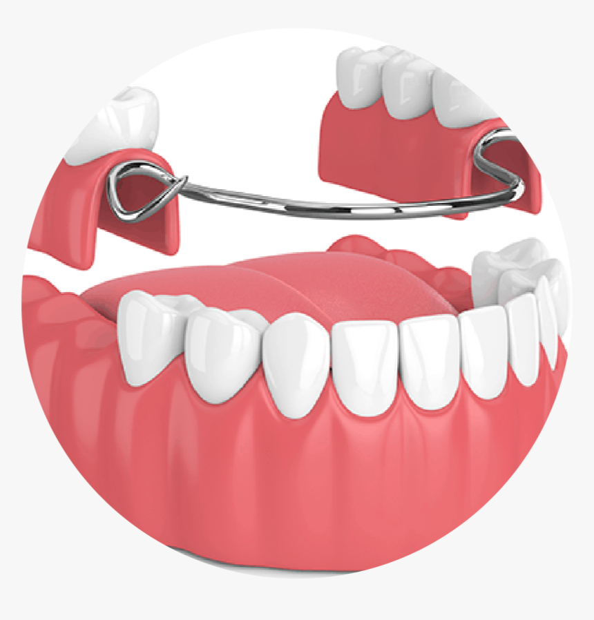 Dental Denture, HD Png Download, Free Download