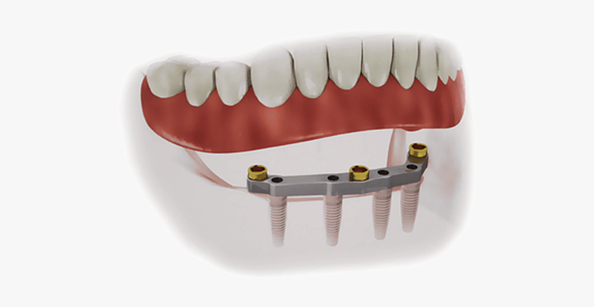 Removable Implant Overdentures - Implant Supported Denture, HD Png Download, Free Download