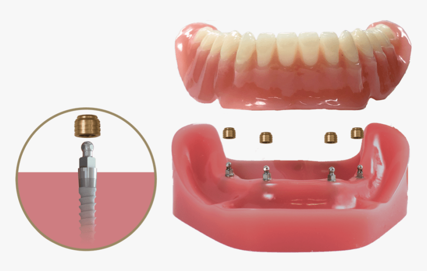 Mor Mini Implants - Bicycle Pedal, HD Png Download, Free Download