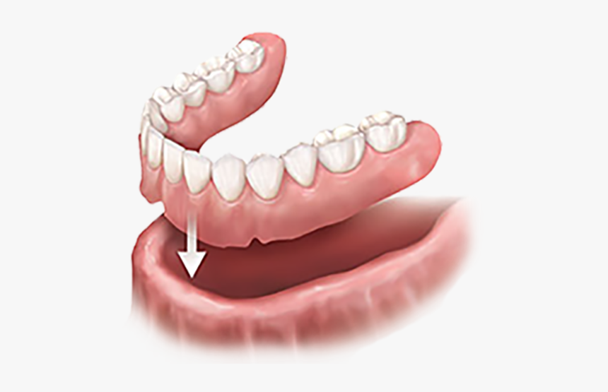 Implant Overdenture, HD Png Download, Free Download