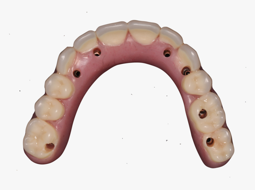 Fixed Implant Supported Dentures, HD Png Download, Free Download