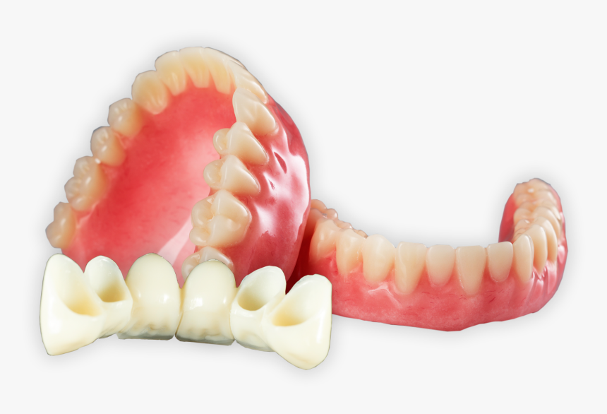 Dentures Bridge - Removable Prosthodontics, HD Png Download, Free Download