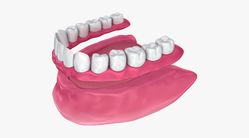 Traditional Denture - Charleston, Sc - Dentures Types, HD Png Download, Free Download