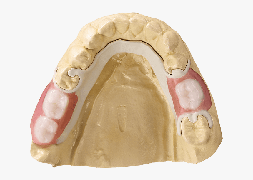 Ultaire Akp Removable Partial Denture In Model - Polymer Removable Partial Denture, HD Png Download, Free Download