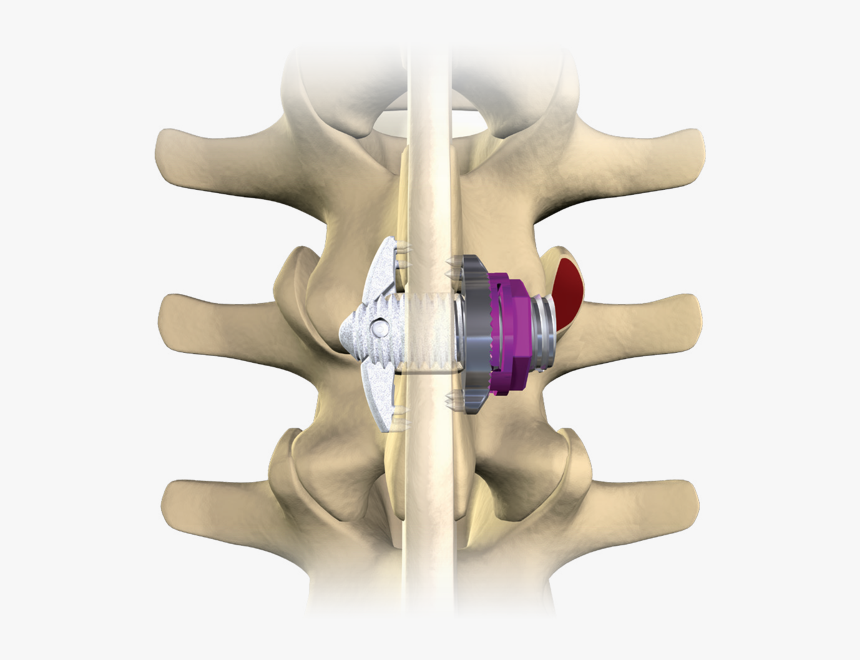 Minuteman Spinal Implant, HD Png Download, Free Download