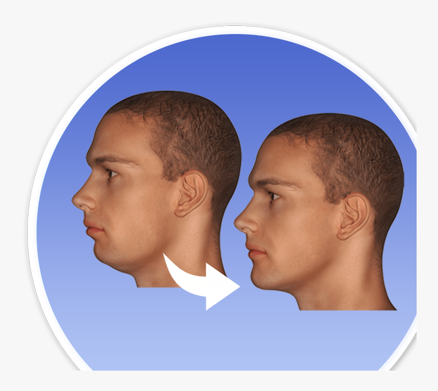 Before And After Jaw Surgery - Maxillofacial Jaw Surgery, HD Png Download, Free Download