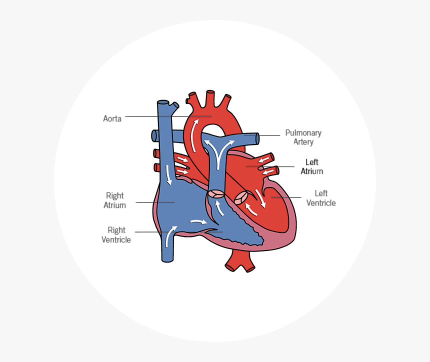 Asd Blood Flow - Hypoplastic Left Heart Syndrome Surgeries, HD Png Download, Free Download