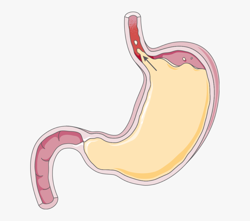 Gastroesophageal Reflux Disease Transparent, HD Png Download, Free Download