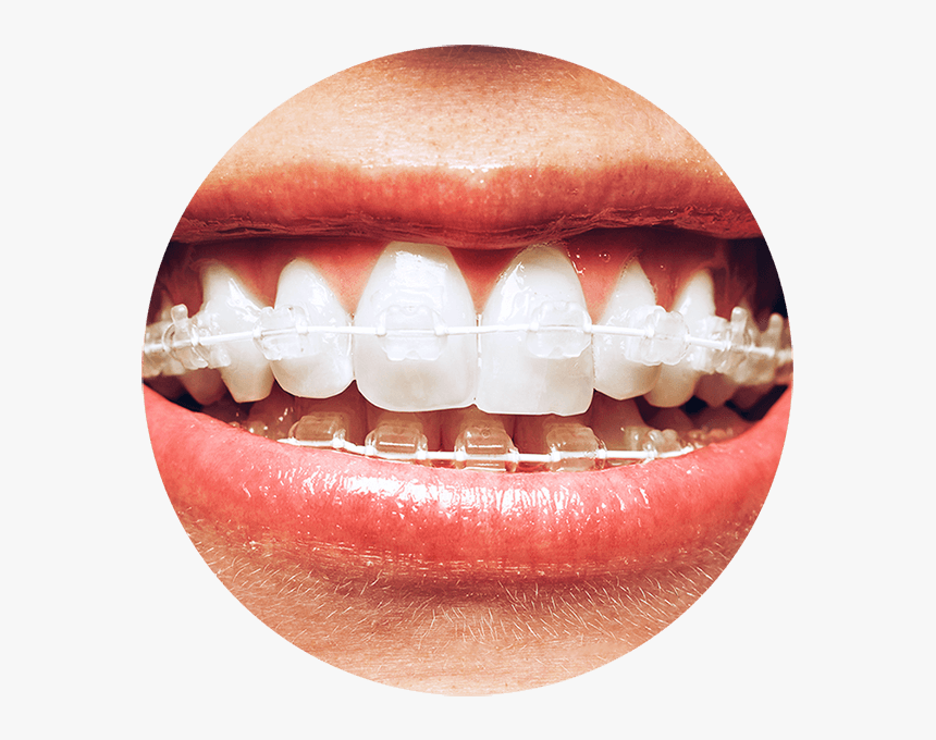 6 Month Smile Braces, HD Png Download, Free Download