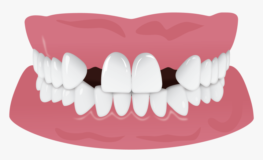 Invisalign Gap Teeth Missing Tooth, HD Png Download - kindpng.