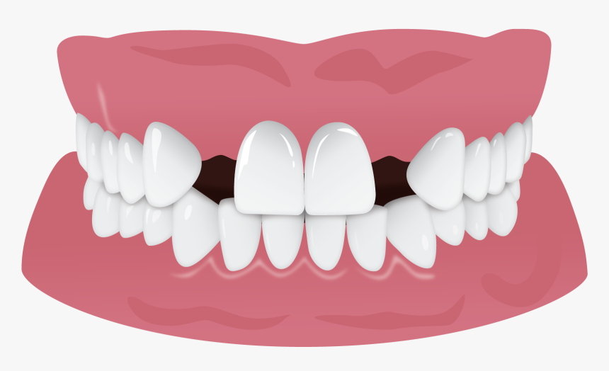 Invisalign Gap Teeth Missing Tooth, HD Png Download, Free Download