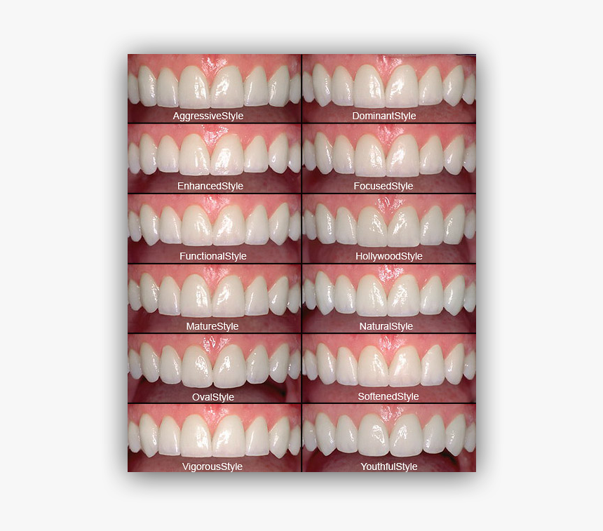 Different Styles Of Veneers, HD Png Download, Free Download