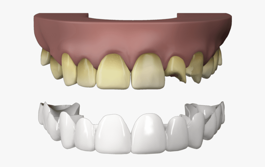 Press On Veneers Teeth - Dental Technician, HD Png Download, Free Download