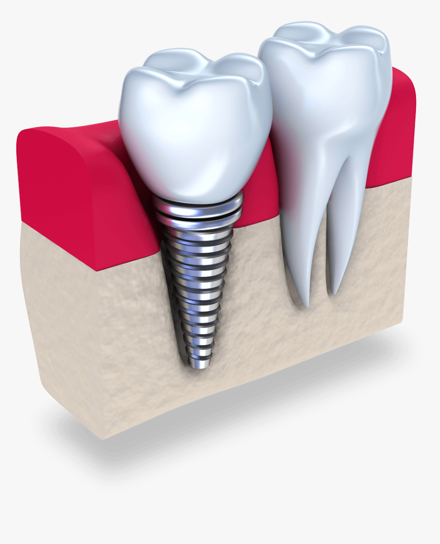 Implant Tooth Cost In Singapore, HD Png Download, Free Download