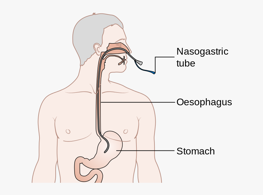 Correct Placement Of Ng Tube Cancer Research Uk/wikimedia - Tube Nasogastric, HD Png Download, Free Download