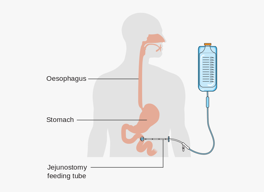 Fj Feeding Tube, HD Png Download, Free Download