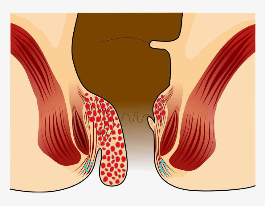 Fistula And Piles Difference, HD Png Download, Free Download