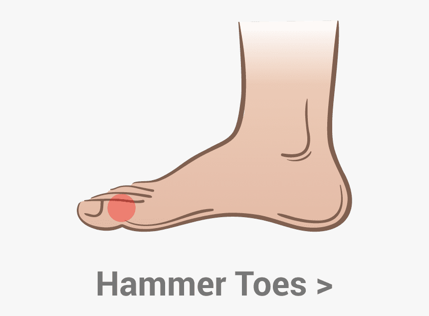 Hammer-toes - Osselets De L Oreille, HD Png Download, Free Download
