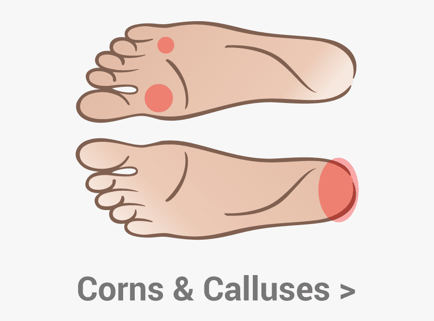 Corns And Calluses - Bump Under Big Toe Joint, HD Png Download, Free Download