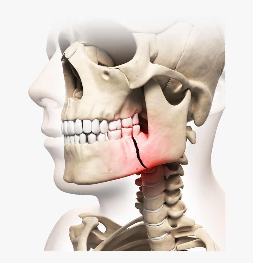 Illustration Of Skull With Broken Jaw Highlighted In - Jaw Fracture, HD Png Download, Free Download