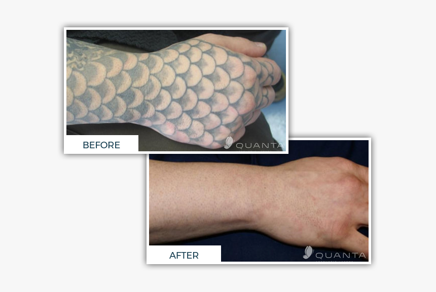 Chroma Tattoo Studio & Laser Tattoo Removal Clinic - Tattoo Removal Cover Up, HD Png Download, Free Download