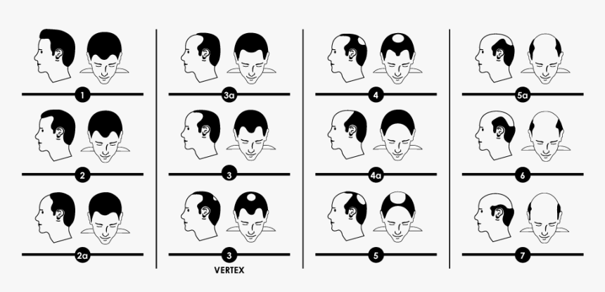 Norwood Scale For Male Hair Loss , Png Download - Scalp Micropigmentation Art, Transparent Png, Free Download