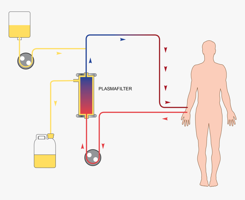 Plasma Exchange Plasmapheresis, HD Png Download, Free Download