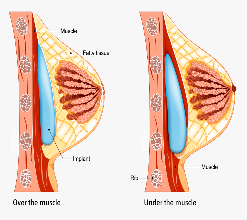 Breast Augmentation Dual Plane Technique, HD Png Download, Free Download