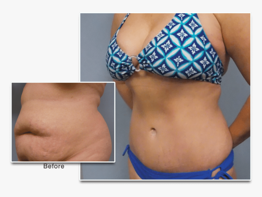 Mommymakoverba - Tummy Tuck Breast Lift Before And After, HD Png Download, Free Download