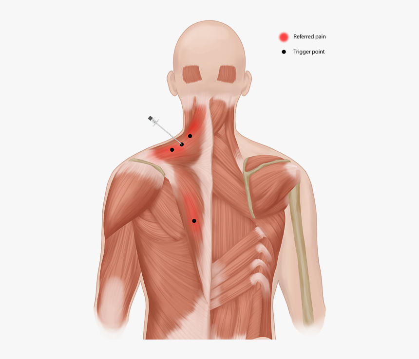 Trigger-pain - Botulinum Toxin For Neck Pain, HD Png Download, Free Download