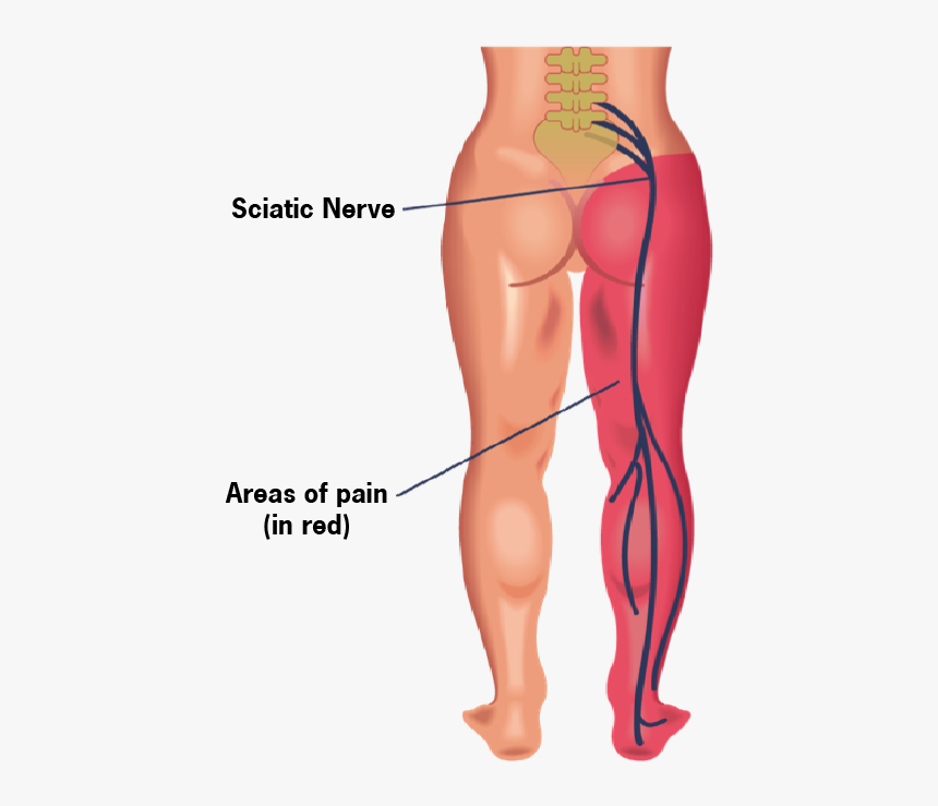 Sciatica Leg Pain - Sciatica Pain, HD Png Download, Free Download