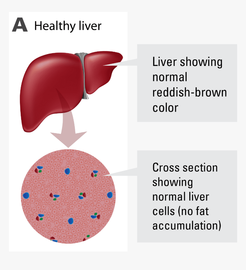 Liver Normal And Abnormal, HD Png Download, Free Download
