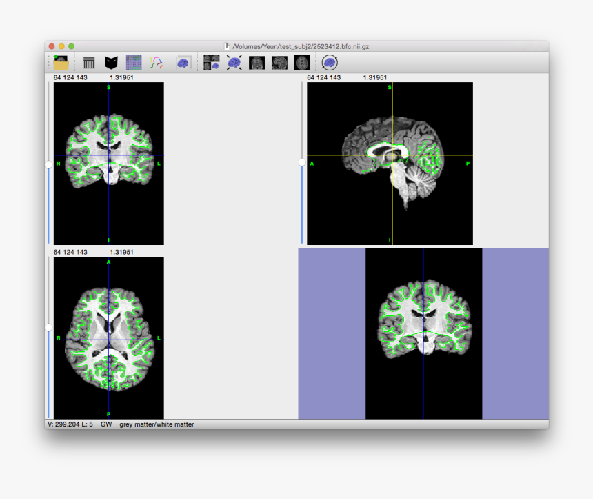 Whats Bias Field Correction, HD Png Download, Free Download