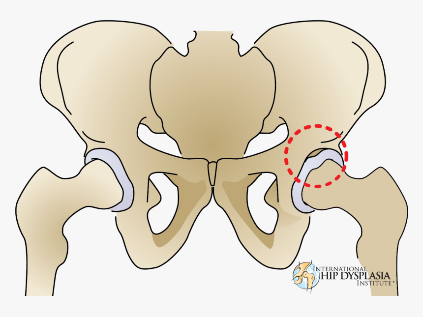 Where Torn Labrums Happen - Hip Dysplasia Torn Labrum, HD Png Download, Free Download