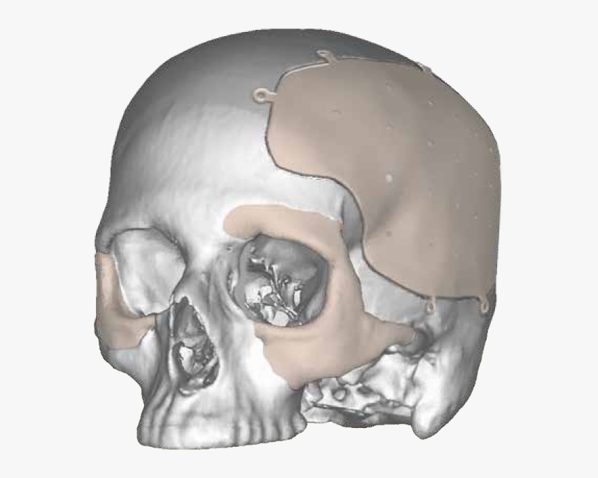 Cranial Implant Fixation System, HD Png Download, Free Download