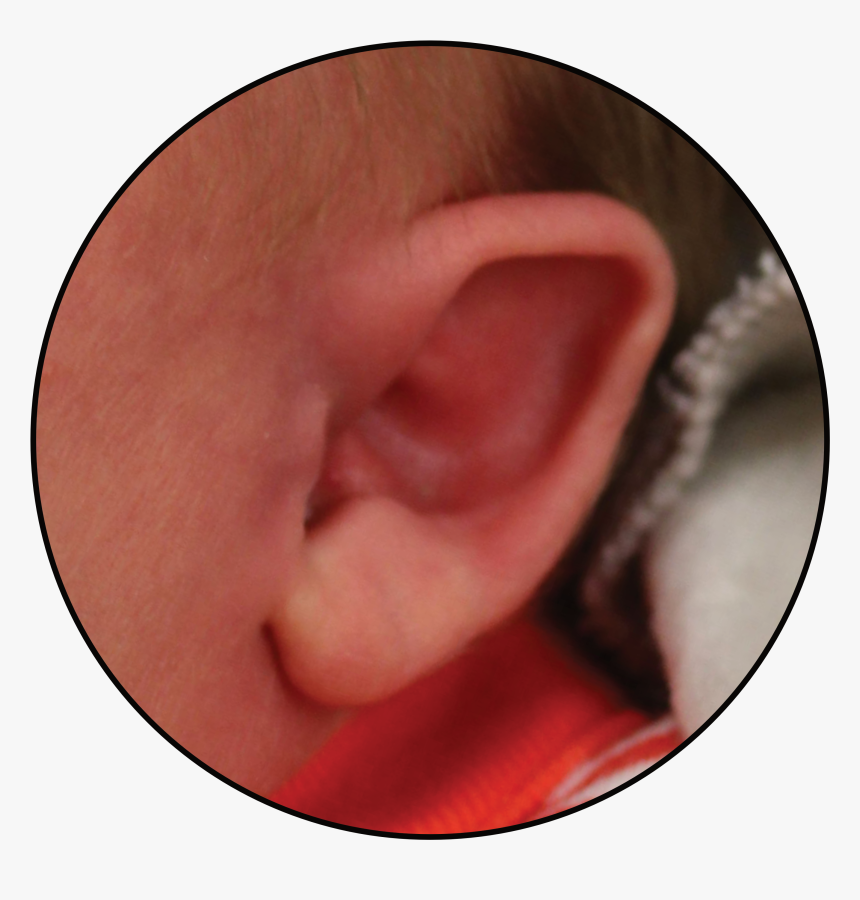 Baby Born With Folded Down Ear - Have A Perfect Straight Narroe Ears, HD Png Download, Free Download