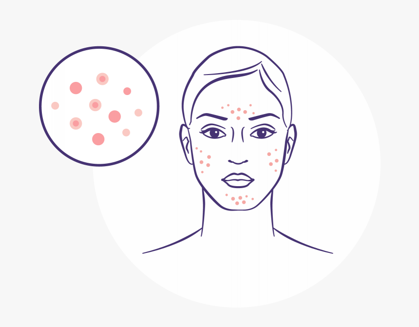 Acne Treatment - Illustration, HD Png Download, Free Download