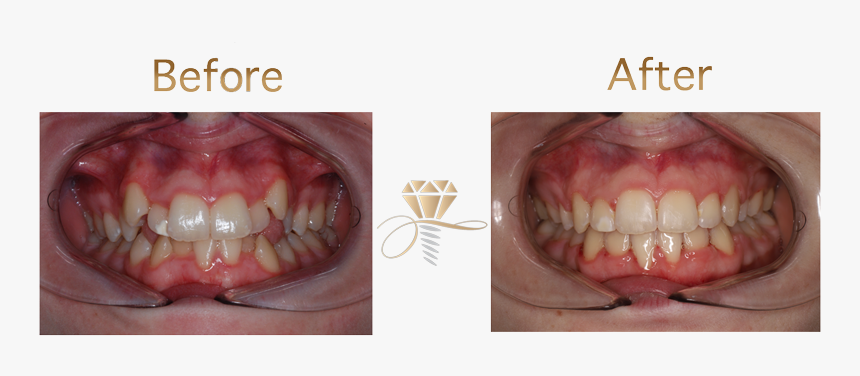 After Diamond Dental - Clear Aligners, HD Png Download, Free Download