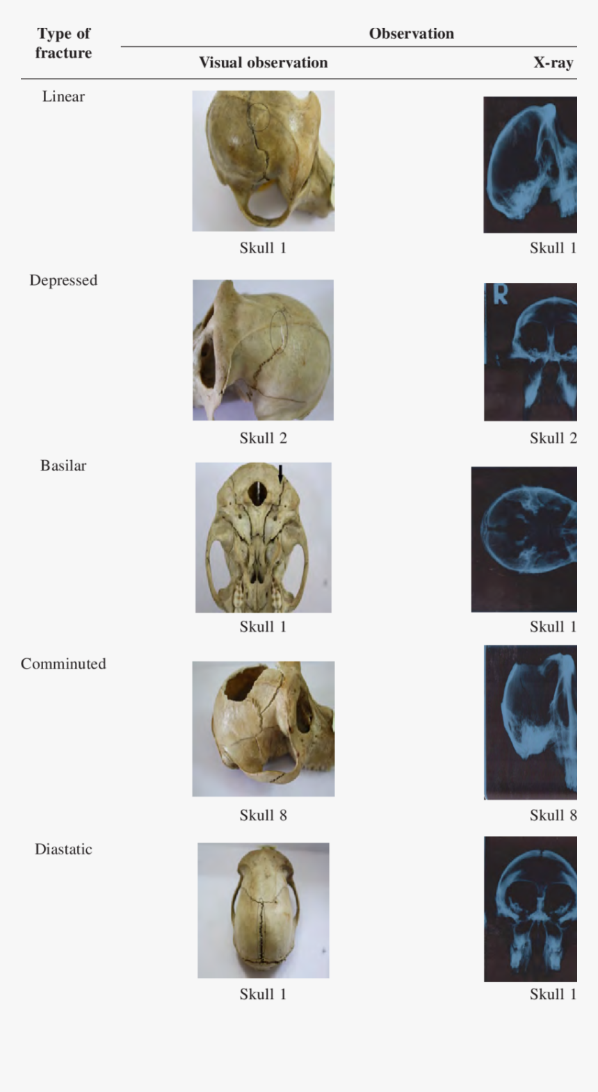 Types Of Fracture Of Skull, HD Png Download, Free Download