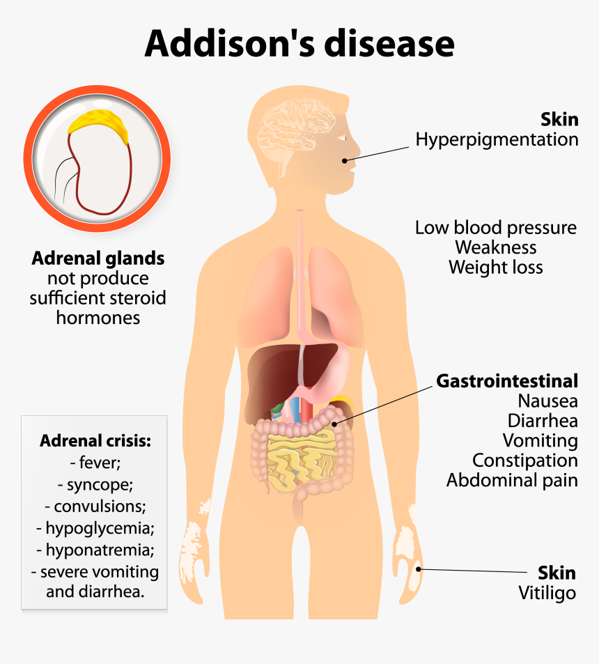 Underactive Adrenal Gland, HD Png Download, Free Download