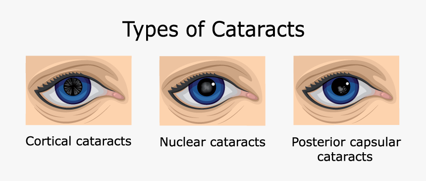 Nuclear Cataract Vs Cortical Cataract, HD Png Download, Free Download