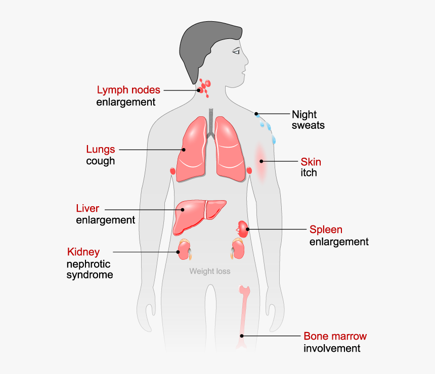 Side Effects From Exposure - Man Lymphoma Cancer Symptoms, HD Png Download, Free Download