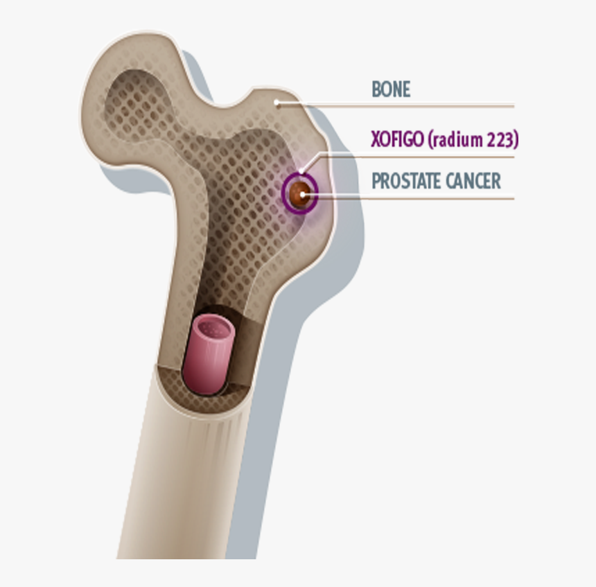 Bone - Xofigo Radium 223, HD Png Download, Free Download